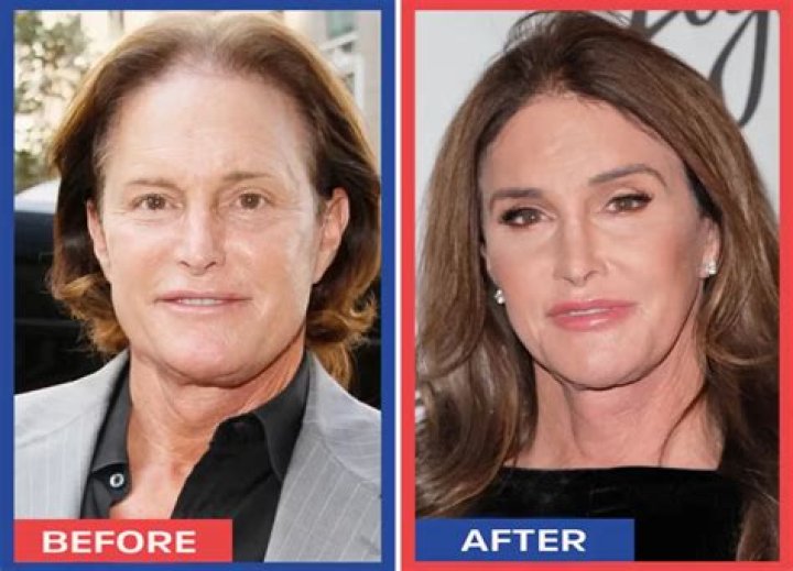Bruce Jenner: Did He Have Sex Change Operation? — Shocking New Report